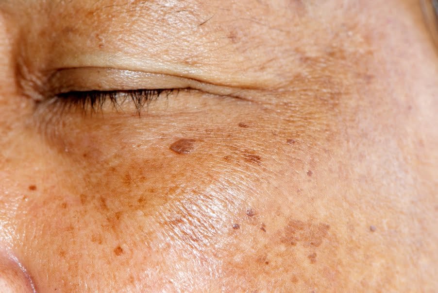 melasma