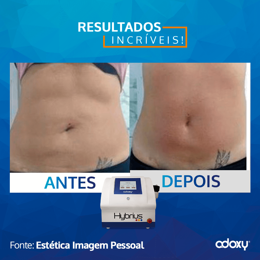 Umbigo Triste: Como tratar e antes x depois