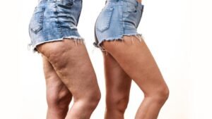 o que é lipedema