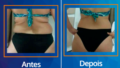 Resultado da radiofrequência no tratamento contra gordura localizada