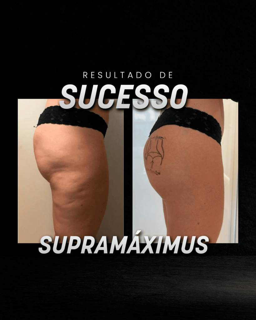 Aumento do bumbum após tratamento com o Supramáximus